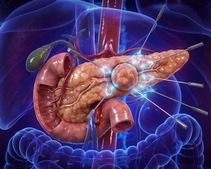 Reversible Electroporation - Abdominal Tumors