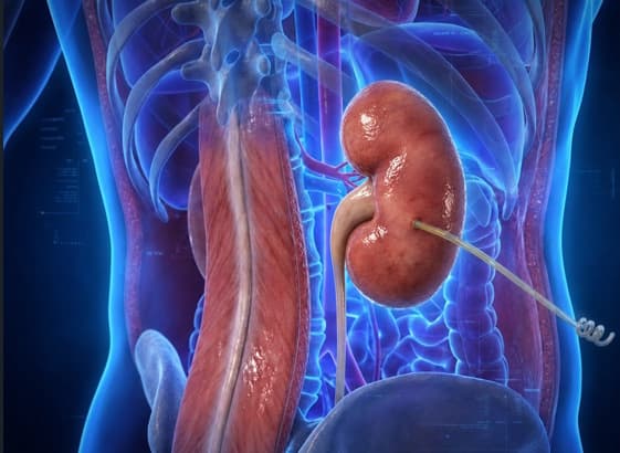 Percutaneous Nephrostomy