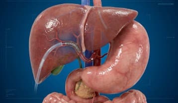 Abdominal Embolization