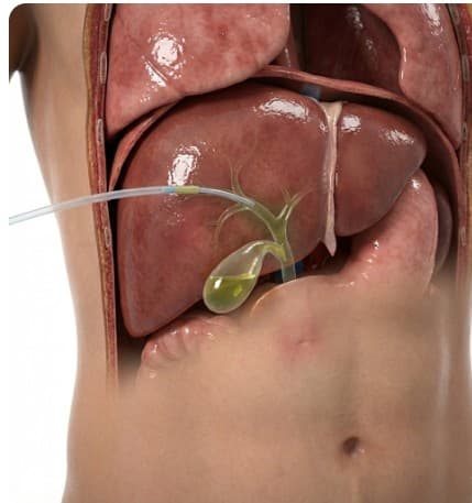 Biliary Drain Placement