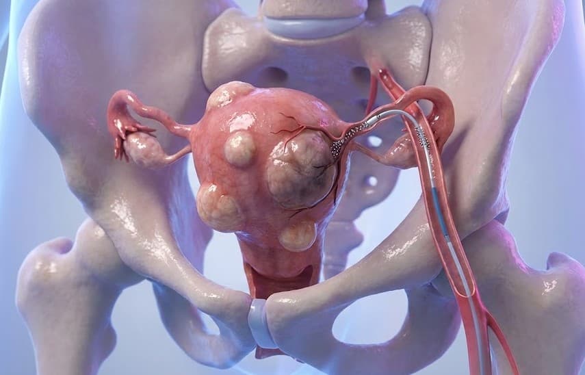 Uterine Fibroid Embolization