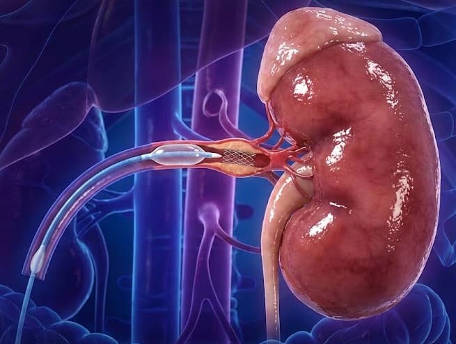 Renal Artery Dilatation