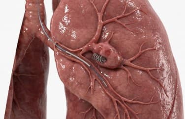 Embolization Malformations
