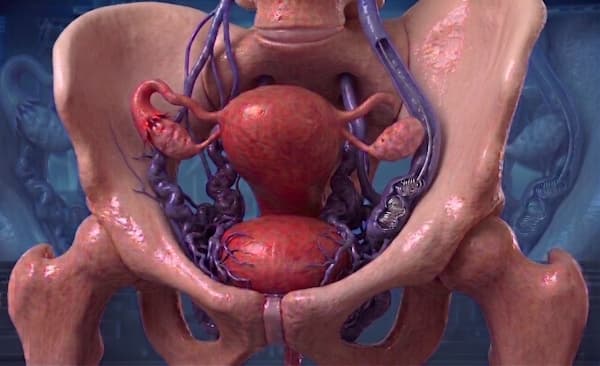 Pelvic Vein Embolization