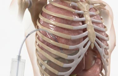 Chest Drain Insertion