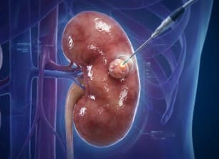 Abdomen Tumor Ablation.jpg